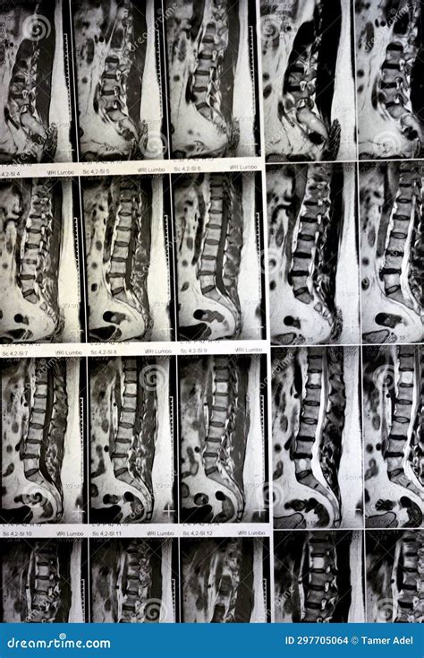 Mri Lumbosacral Spine Without Contrast Revealed Back Muscle Spasm Mild