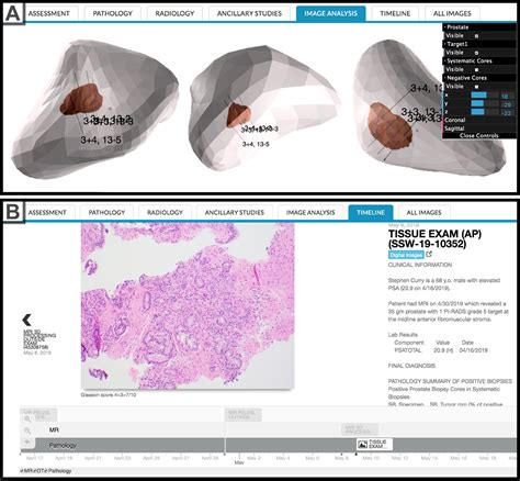 An Electronic Form For Reporting Results Of Targeted Prostate Biopsy Urology Integrated