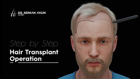 Step By Step Hair Transplant Operation Youtube