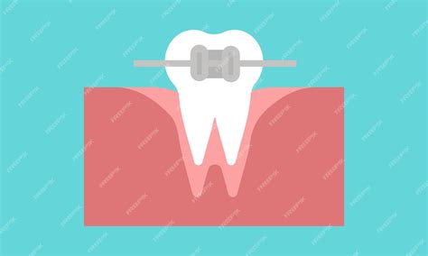 Metalen Beugels Tandheelkundige Orthodontische Tanden Met Beugels