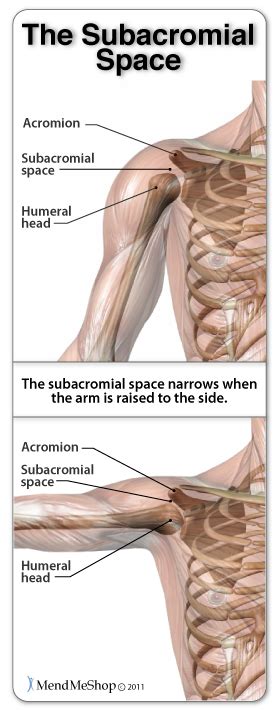 Shoulder Impingement Syndrome