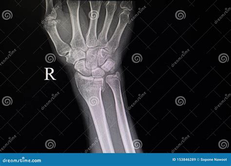 Xray Film Of Fracture Wrist Bones Stock Image Image Of Operation