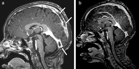 Cerebral Vein Thrombosis In A Four Year Old With Behçets Disease