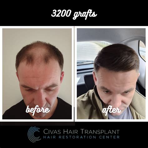 Dr Ekrem Civas Md Before And Afters Iahrs Member