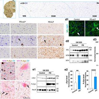 Neurofilament Abnormalities In The White Matter Underlying The Motor