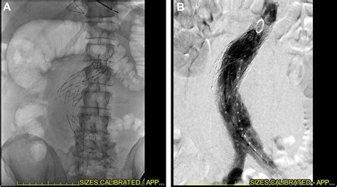 Predictors Of Type Iiia Endoleak After Endovascular Aortic Repair With