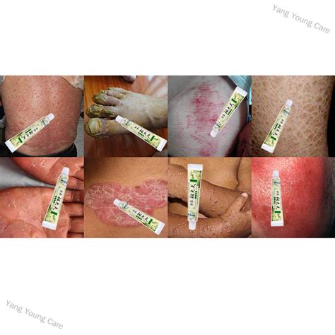 Yang Young Care Psoriasis Eczema Ointment Dermatitis Vitiligo Skin Rash