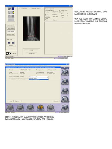 Densitometría Osea Antebrazo Pdf