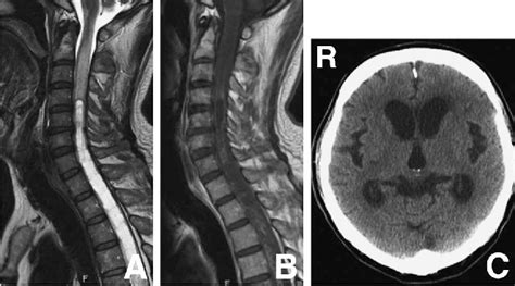 Figure 1 From Radiation Induced Spinal Cord Anaplastic Astrocytoma