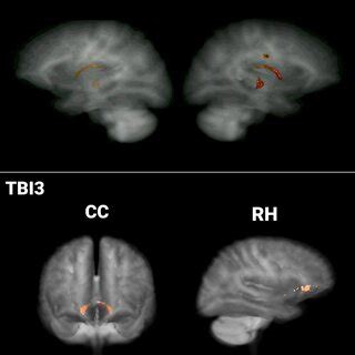 Individualised profile of TBI1 and TBI3, presenting the back-projection ...
