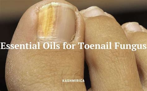 What Are The 4 Best Essential Oils For Toenail Fungus Kashmirica