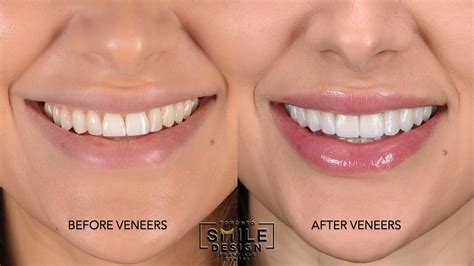 Perfecting Your Smile The Art Of Shade Selection In Dental Porcelain Veneers