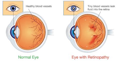 Diabetic Retinopathy What Is It Causes And Treatment