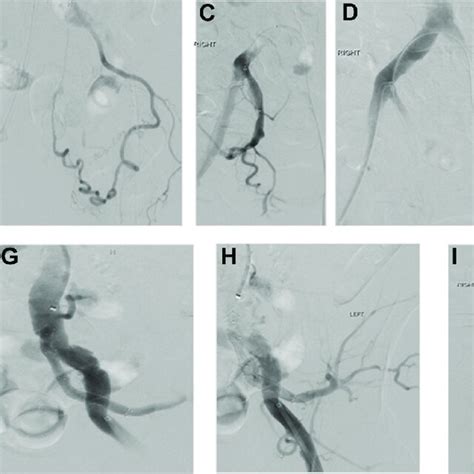 Intraoperative Imaging Showing Occlusion Of Bilateral Internal Iliac Download Scientific