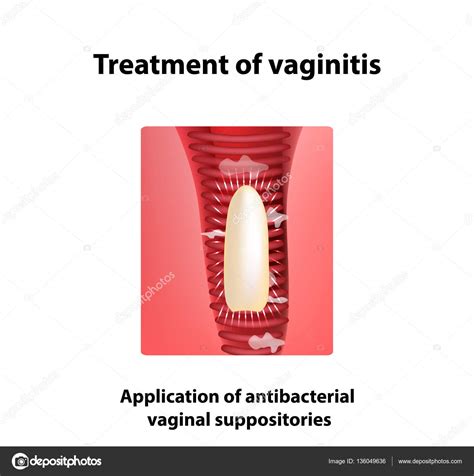 Vaginitis Diagram