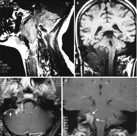 Jugular Foramen Tumors Diagnosis And Management Neupsy Key