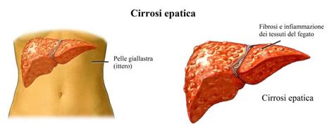 Steatosi Epatica Sintomi E Cause Alcolica Fegato Grasso Cirrosi