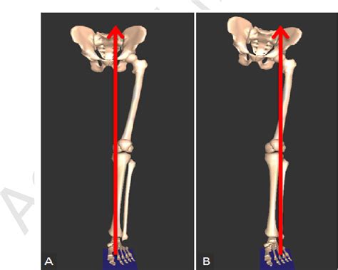 Weak Hip Abductors