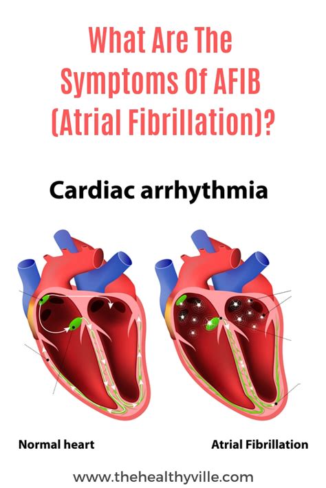 Afib Signs And Symptoms