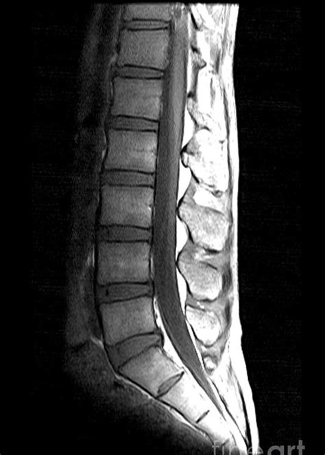 Normal Lumbar Mri Images