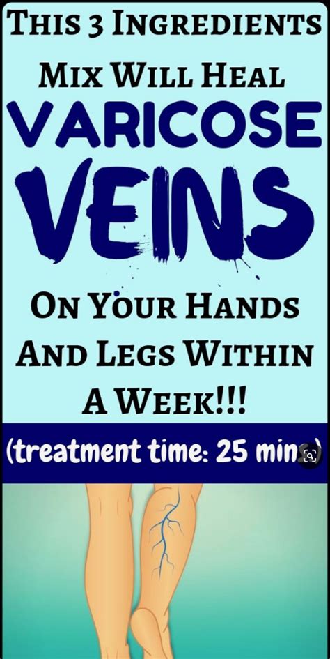 Heal Your Varicose Veins With This Great Mix