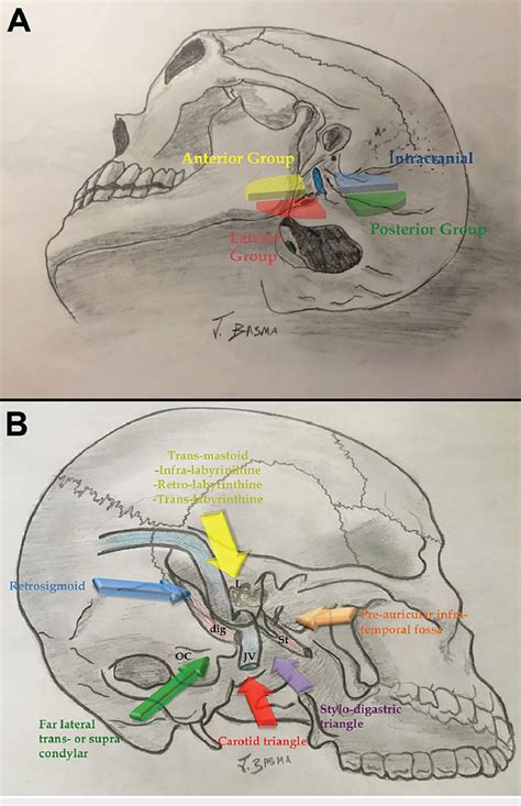 Jugular Foramen Approaches A Illustration Depicting An Adapted