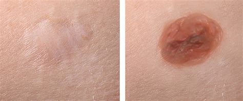 Understanding Scarring After Mole Removal Surgery