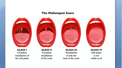 Anesthesia Mallampati Score Grading Mp Airway Evaluation Open Mouth