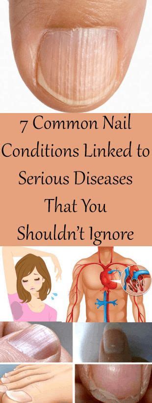 7 Common Nail Conditions Linked To Serious Diseases That You Shouldn’t Ignore Healthy Bright