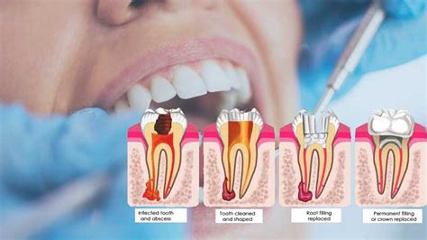 Root Canal Therapy In Brampton A Comprehensive Guide Photoshoponline