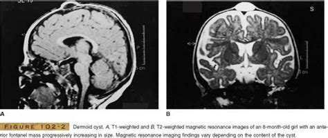 Epidermoid And Dermoid Neuro Oncology Mitch Medical