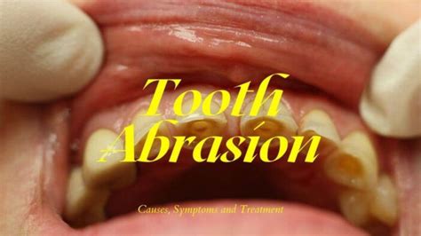 Tooth Abrasion: Causes, Symptoms And Treatment [Complete Explanation] » 2024