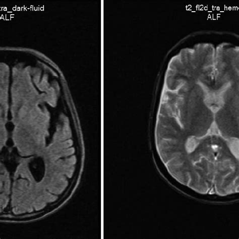 Resonancia magnética cerebral simple Se muestran imágenes axiales en