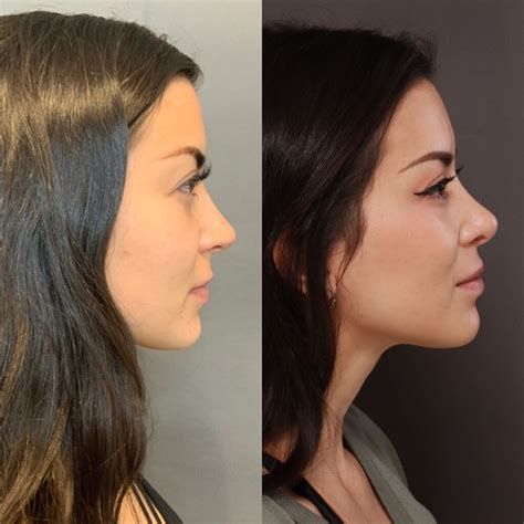 Rhinoplasty Experts Salt Lake City Ut Nose Jobs Utah Facial Plastics