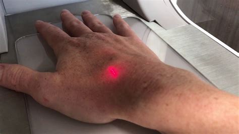 Fractional Co2 Laser Hand Resurfacing Youtube