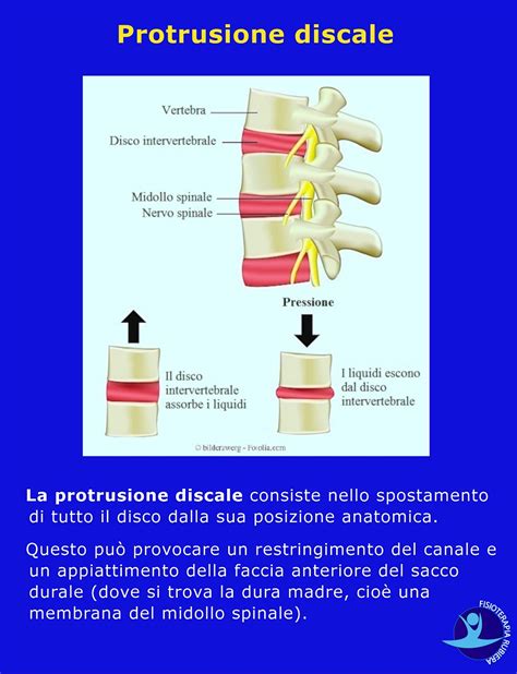 Protrusione Discale E Bulging I Veri Sintomi La Terapia E Gli Esercizi