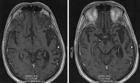 Neuropathologies Underlying Acquired Language Disorders Neupsy Key