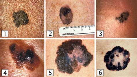 Melanoma Skin Cancer Stages