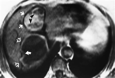 Hydatid Disease Radiologic And Pathologic Features And Complications Radiographics