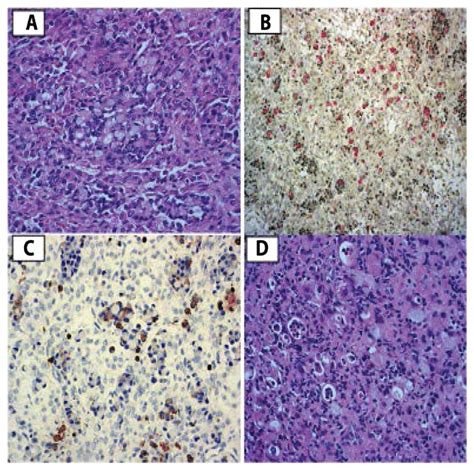 A Ovary Signet Ring Cells Infilterating The Ovary Pathognomic Of