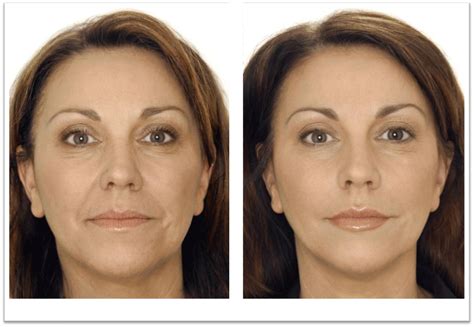 Botox Around Lips Before And After Pictures - Infoupdate.org