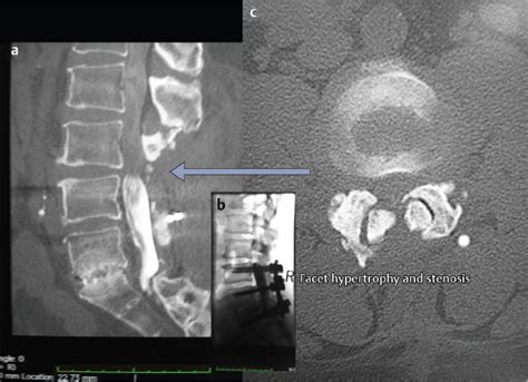 Minimally Invasive Laminectomy For Lumbar Stenosis Neupsy Key