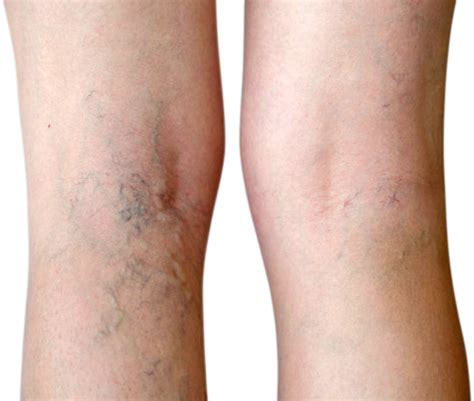 Vein Therapy Dayton OH | Advanced Therapeutics