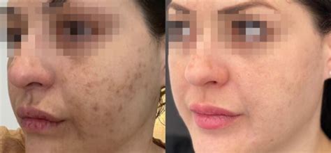 Secret Pro Skin Appearance Treatment Dr Yusra