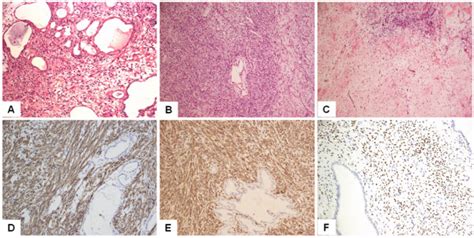 Representative Pathological Findings Of Mixed Epithelial And Stromal