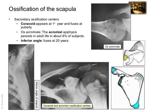 Imaging anatomy fracture of the scapula