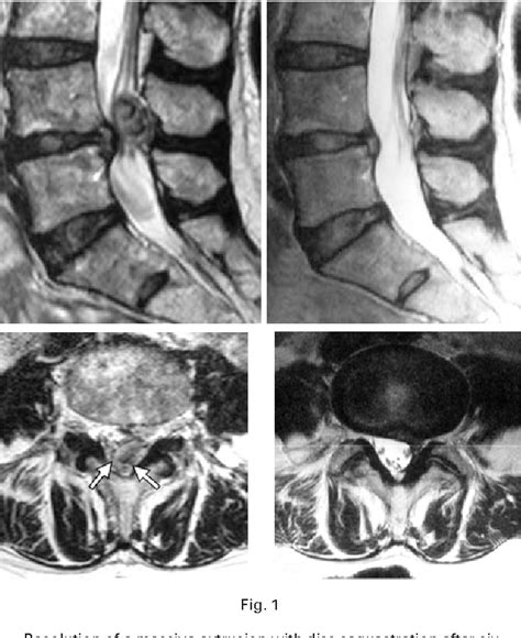 Figure 1 From Observations On The Natural History Of Massive Lumbar