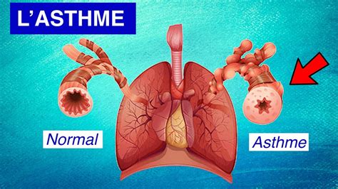 Asthme bronchique Physiopathologie Symptômes et Traitements YouTube