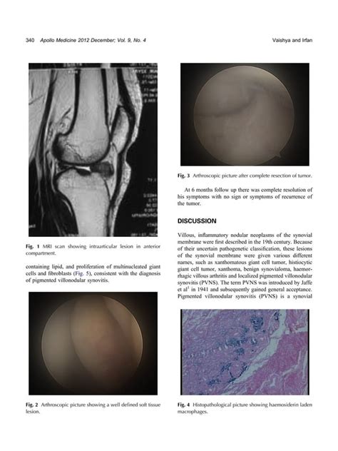 Arthroscopic Resection Of Localized Pigmented Villonodular Synovitis Of