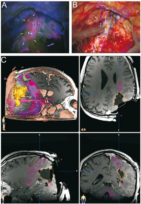 Fluorescence Guided Tumor Localization And Eloquent Area Visualization